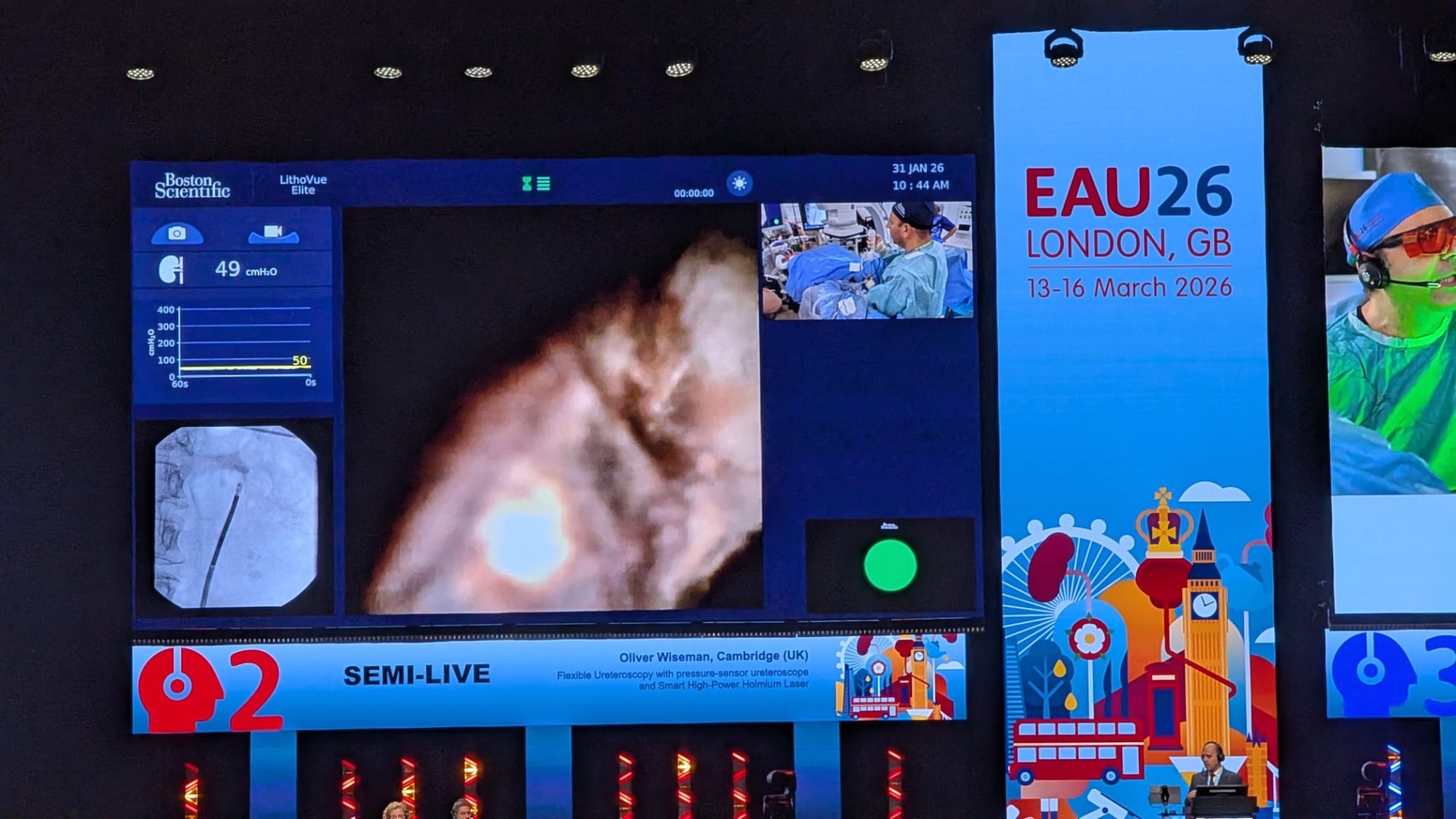 Live ureteroscopy procedure screen at EAU26 London